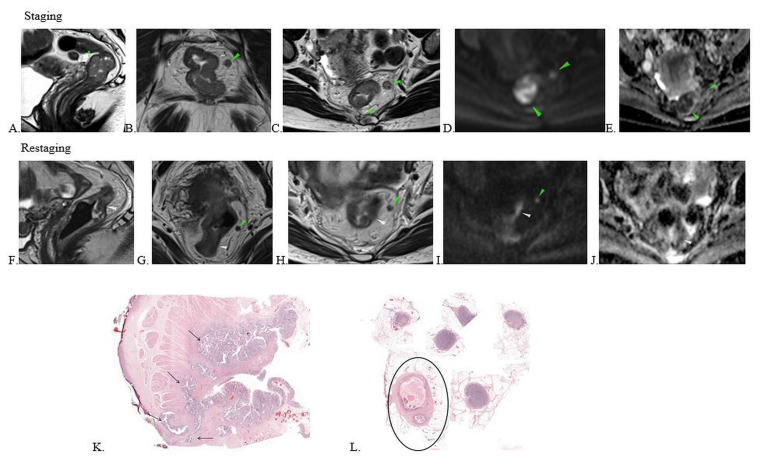 Preoperative MRI accuracy after neoadjuvant chemoradiation for locally advanced rectal cancer.