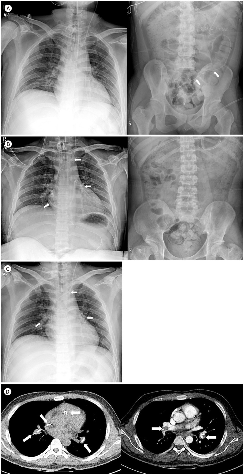 Distal Ventriculoperitoneal Shunt Catheter Migration into the Pulmonary Vasculature and Cardiac Chamber: A Case Report.