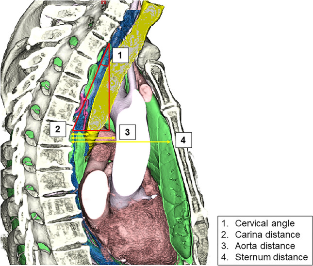 Predictors of the difficulty of transcervical subcarinal lymph node dissection for esophageal cancer.