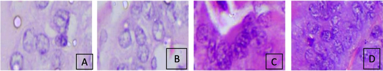 A study to evaluate association of nuclear grooving in benign thyroid lesions with RET/PTC1 and RET/PTC3 gene translocation.