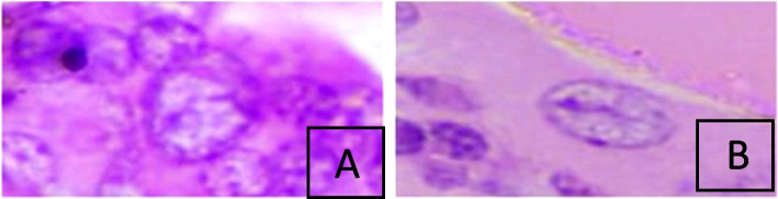 A study to evaluate association of nuclear grooving in benign thyroid lesions with RET/PTC1 and RET/PTC3 gene translocation.