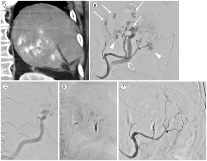 [Clinical Role of Interventional Radiology in Abdominal Solid Organ Trauma].