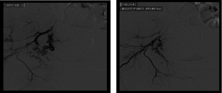 Hysterectomy Sparing Management of Uterine Necrosis following Uterine Artery Embolization for Postpartum Hemorrhage.