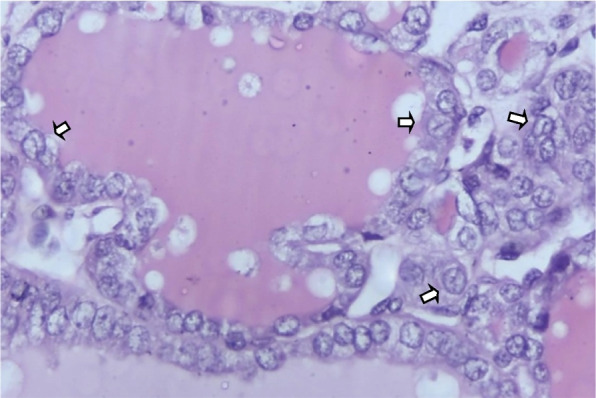 A study to evaluate association of nuclear grooving in benign thyroid lesions with RET/PTC1 and RET/PTC3 gene translocation.