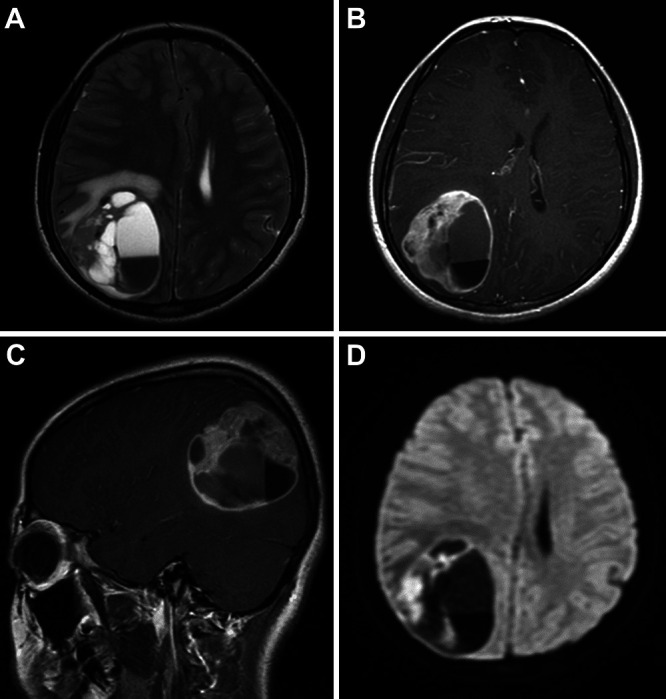 Detailed molecular and pathological analyses of primary intracranial embryonal rhabdomyosarcoma with a BRAF mutation: illustrative case.