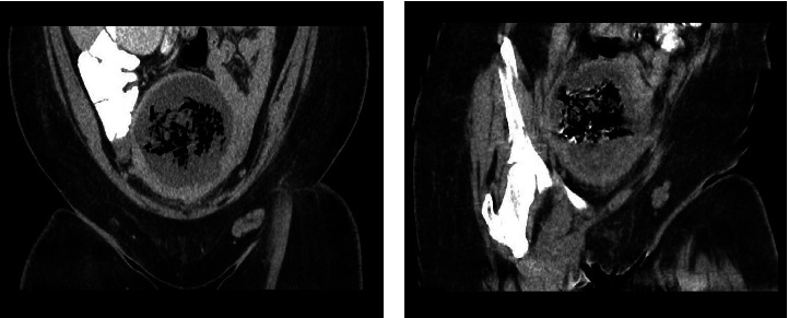 Hysterectomy Sparing Management of Uterine Necrosis following Uterine Artery Embolization for Postpartum Hemorrhage.