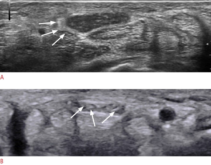 Nerve entrapment syndromes: detection by ultrasound.