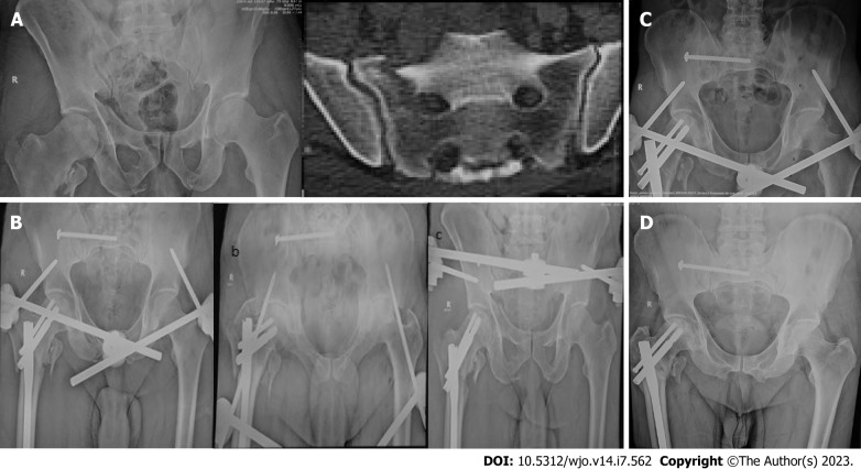 Internal fixator <i>vs</i> external fixator in the management of unstable pelvic ring injuries: A prospective comparative cohort study.