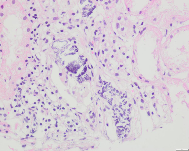 Phosphate Nephropathy in a Patient with Takayasu Arteritis.