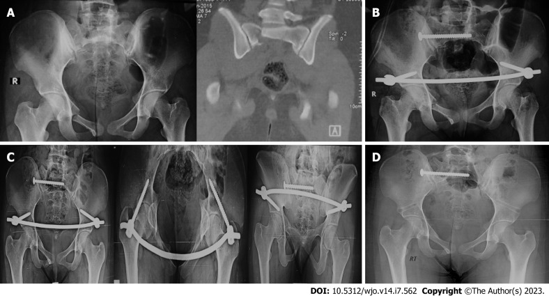 Internal fixator <i>vs</i> external fixator in the management of unstable pelvic ring injuries: A prospective comparative cohort study.