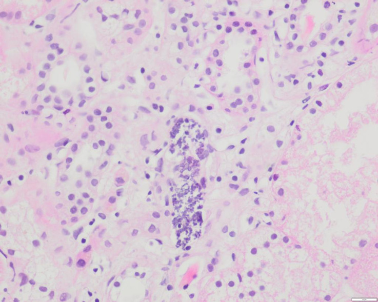 Phosphate Nephropathy in a Patient with Takayasu Arteritis.