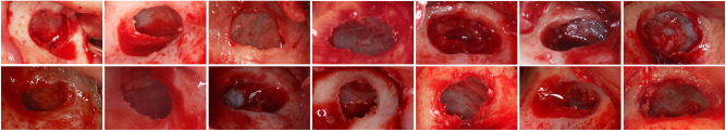 Minimally invasive techniques for lateral maxillary sinus floor elevation: small lateral window and one-stage surgery-a 2-5-year retrospective study.