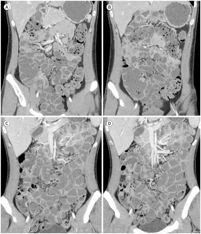 Comparison of the Efficacy of Diluted Polyethylene Glycol and Low-Density (0.1% w/v) Barium Sulfate Suspension for CT Enterography.