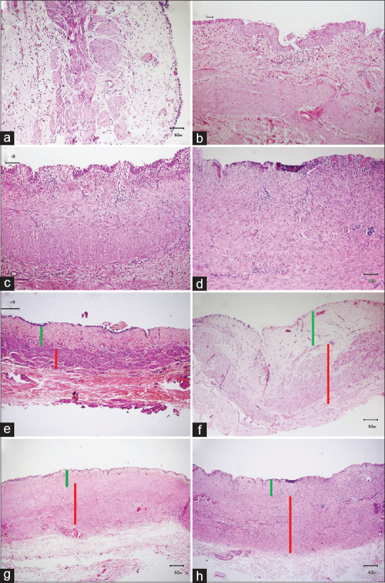 Association between intraoperative anatomical variation and histopathological parameters in cases of ureteropelvic junction obstruction in children: A cross-sectional study.