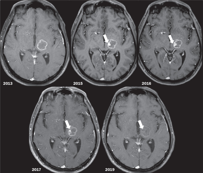 "Star of Bethlehem sign" in the analysis of the evolution of brain lesions during and after treatment for neuroparacoccidioidomycosis.