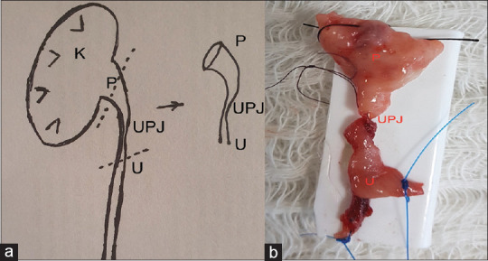 Association between intraoperative anatomical variation and histopathological parameters in cases of ureteropelvic junction obstruction in children: A cross-sectional study.