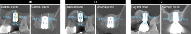 Minimally invasive techniques for lateral maxillary sinus floor elevation: small lateral window and one-stage surgery-a 2-5-year retrospective study.