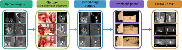 Minimally invasive techniques for lateral maxillary sinus floor elevation: small lateral window and one-stage surgery-a 2-5-year retrospective study.