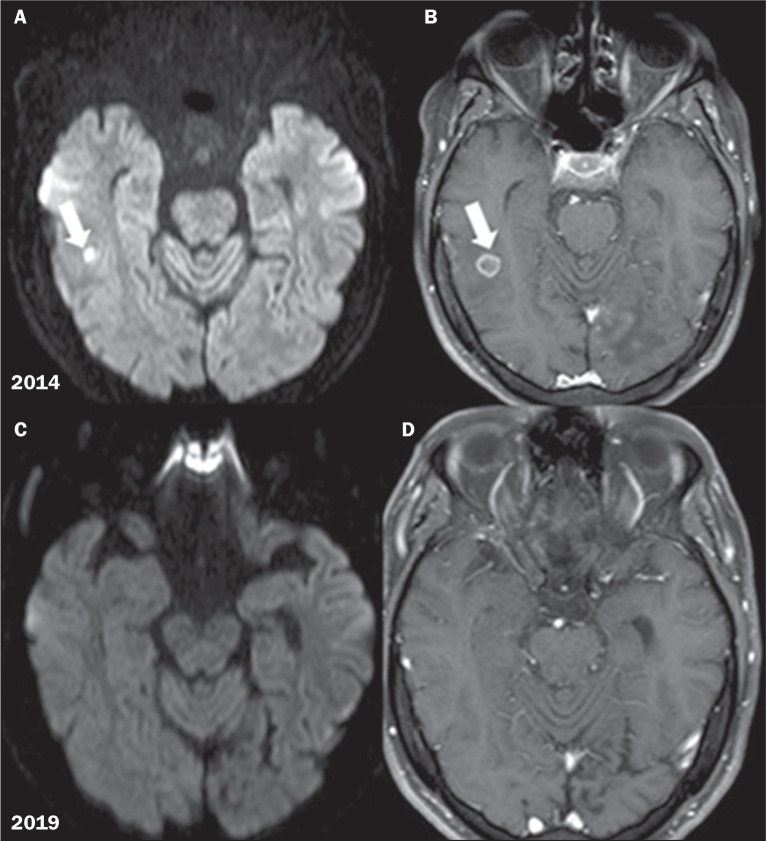 "Star of Bethlehem sign" in the analysis of the evolution of brain lesions during and after treatment for neuroparacoccidioidomycosis.