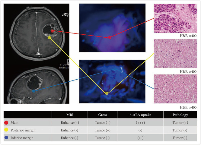 Delayed Detection of a 5-Aminolevulinic Acid <i>In Vivo</i>: A Case of Metastatic Breast Cancer.