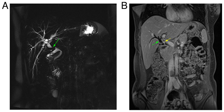 Biliary tree traumatic neuroma following laparoscopic cholecystectomy: A case report and literature review.