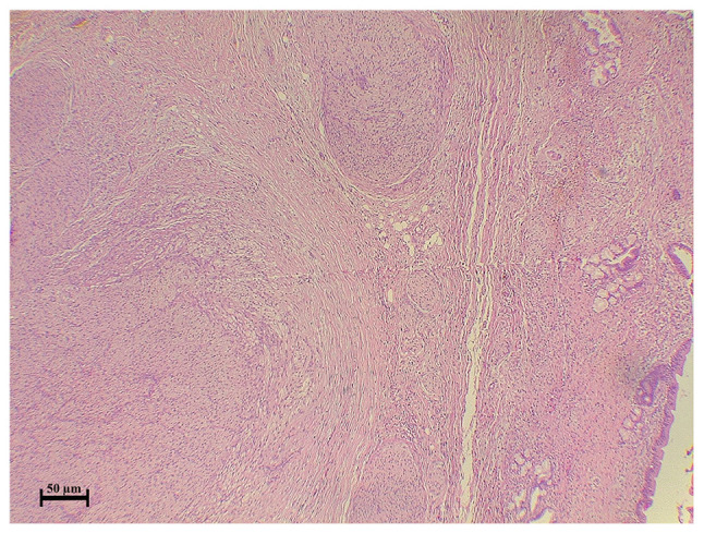 Biliary tree traumatic neuroma following laparoscopic cholecystectomy: A case report and literature review.