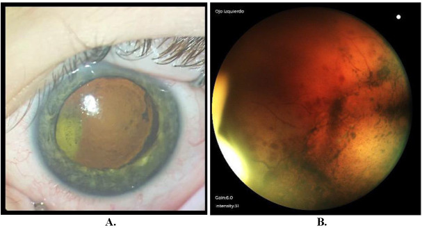 Toxicity to intravitreal melphalan in a patient with retinoblastoma.