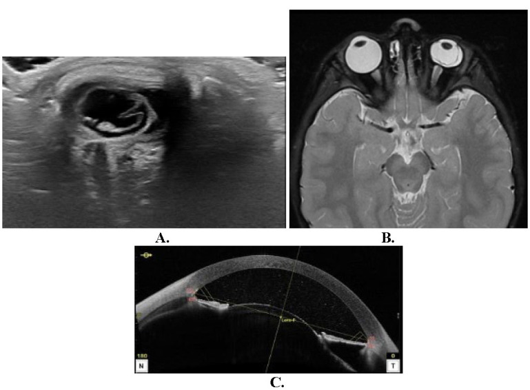 Toxicity to intravitreal melphalan in a patient with retinoblastoma.