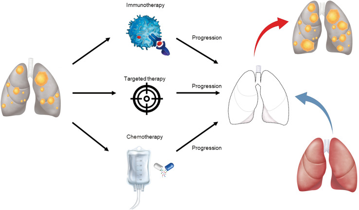 Current and future role of double-lung transplantation for bilateral lung cancer