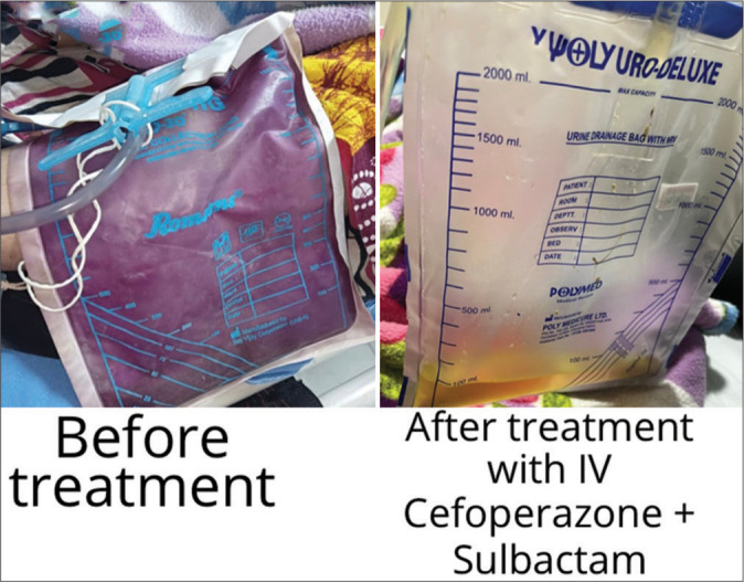 Prolonged Indwelling Percutaneous Nephrostomy Leading to Purple Urinary Bag Syndrome in Palliative Care Setting: A Case Report.