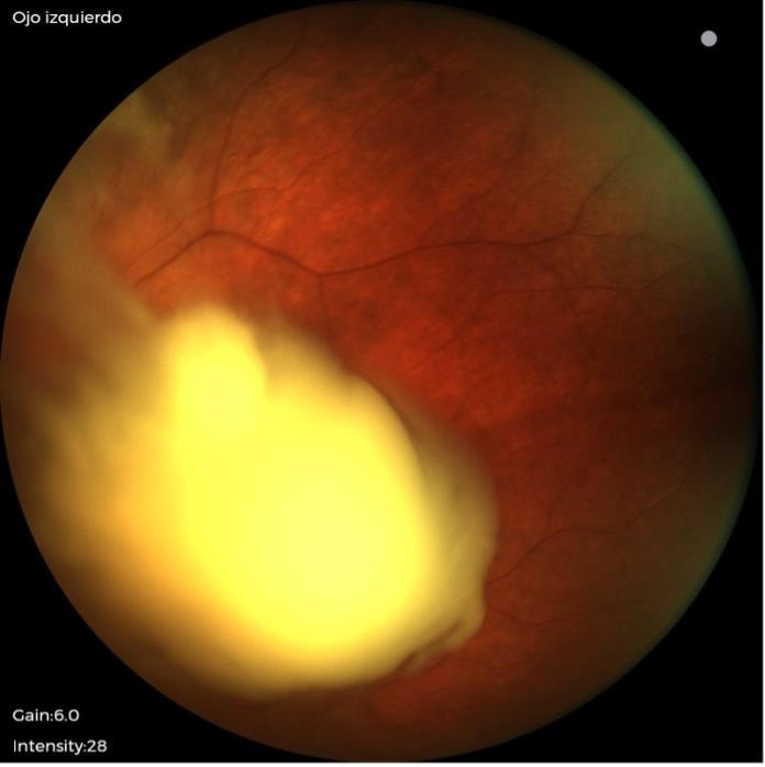 Toxicity to intravitreal melphalan in a patient with retinoblastoma.