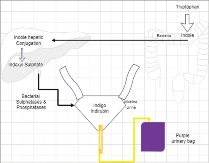 Prolonged Indwelling Percutaneous Nephrostomy Leading to Purple Urinary Bag Syndrome in Palliative Care Setting: A Case Report.