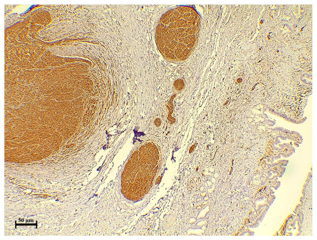 Biliary tree traumatic neuroma following laparoscopic cholecystectomy: A case report and literature review.