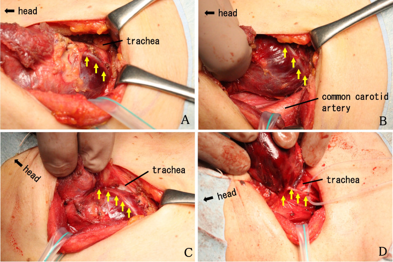 Recurrent laryngeal nerve's course running anteriorly to a thyroid tumor.