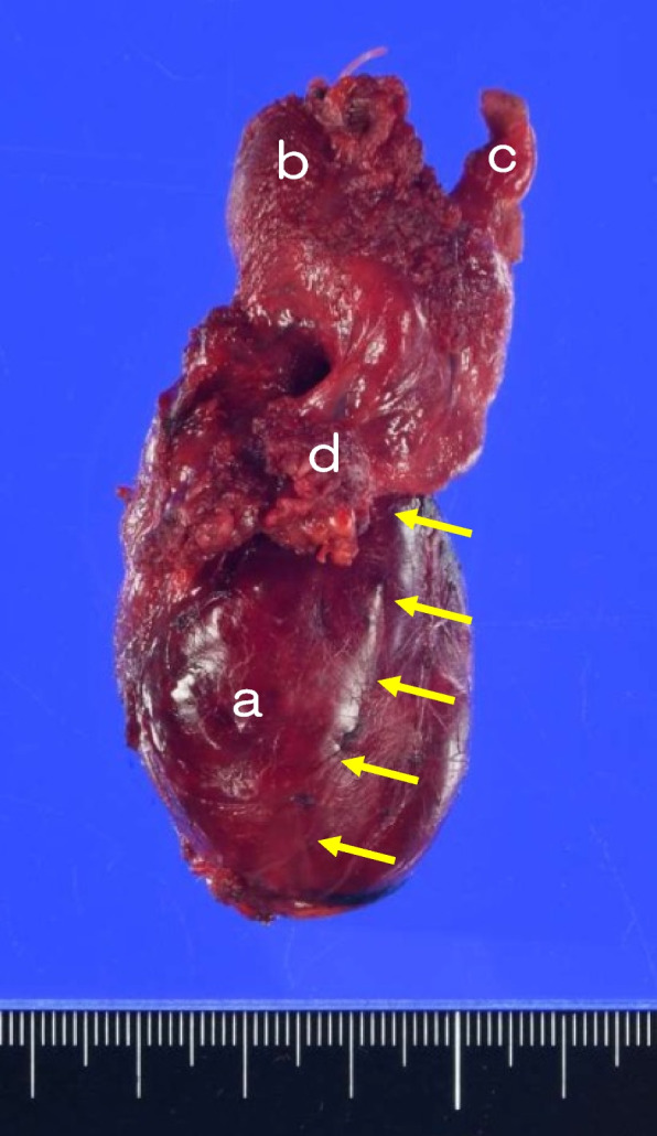 Recurrent laryngeal nerve's course running anteriorly to a thyroid tumor.