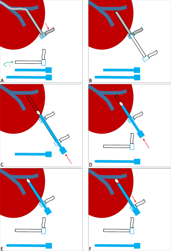 Transsplenic tract closure after transsplenic portalvenous access using gelfoam-based tract plugging.