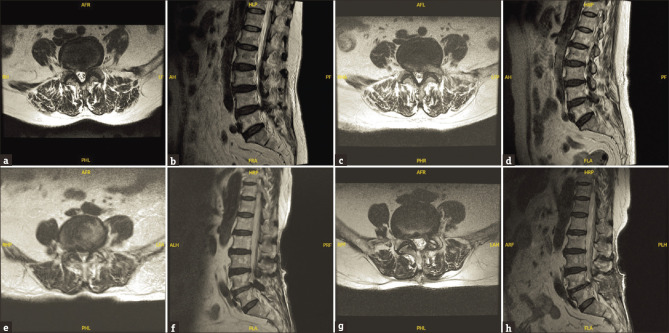 Percutaneous endoscopic lumbar discectomy versus open lumbar microdiscectomy for treating lumbar disc herniation: Using the survival analysis.