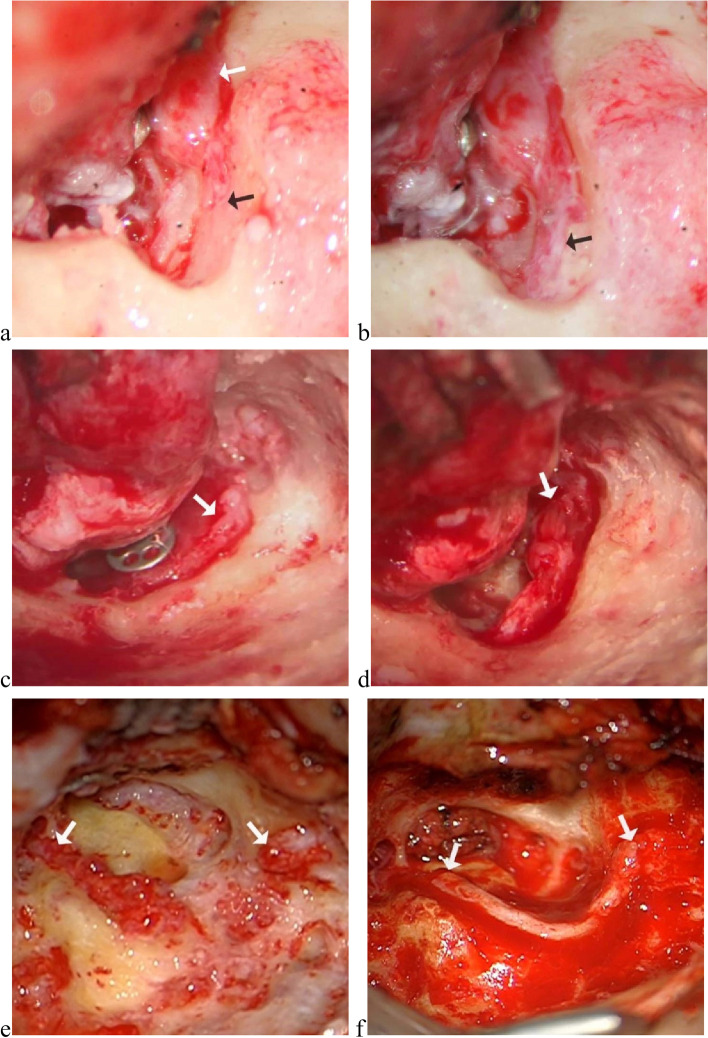 Surgical management and the prognosis of iatrogenic facial nerve injury in middle ear surgery: a 20-year experience.