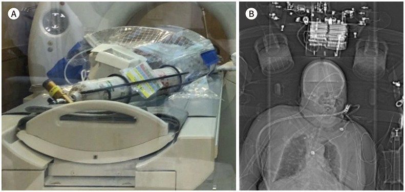 [Expert Opinion Questionnaire About Chest CT Scan Using A Negative Pressure Isolation Strecher in COVID-19 Patients: Image Quality and Infection Risk].