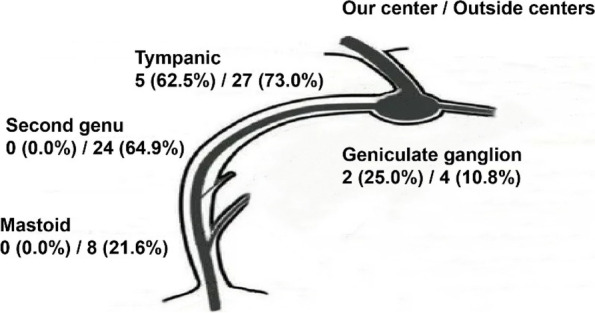 Surgical management and the prognosis of iatrogenic facial nerve injury in middle ear surgery: a 20-year experience.