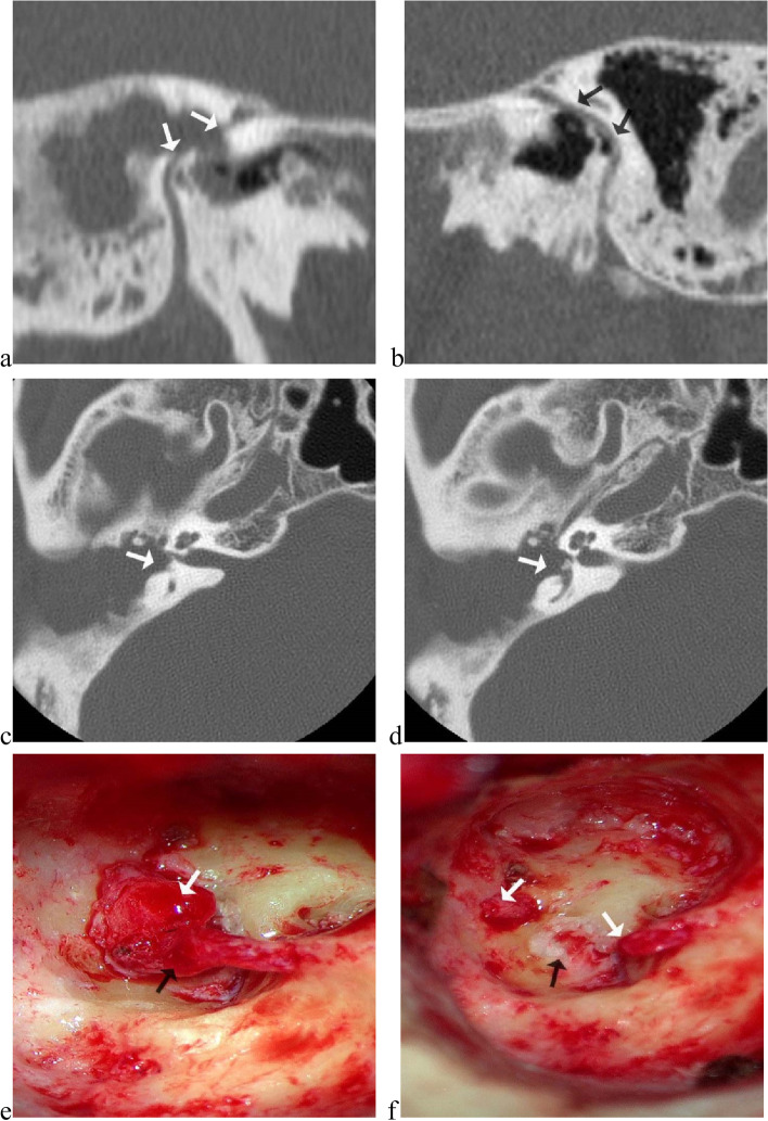 Surgical management and the prognosis of iatrogenic facial nerve injury in middle ear surgery: a 20-year experience.