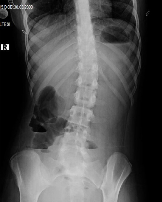 A rare cause of intestinal obstruction in children: signet-ring cell adenocarcinoma of the colon.