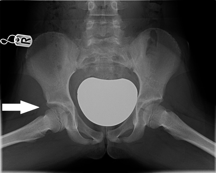 Late Presentation of Tricho-Rhino-Phalangeal Syndrome (TRPS1 Affected) Associated Hip Pathology.