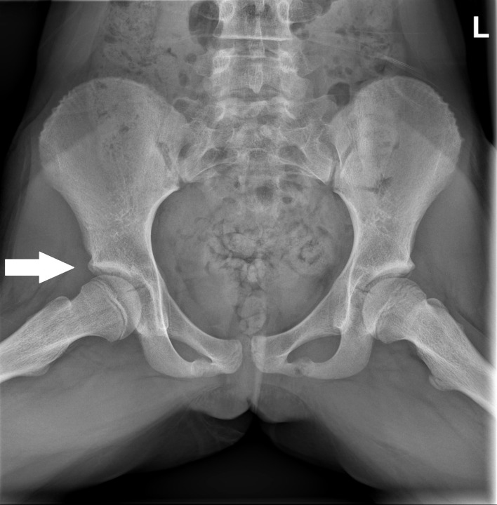 Late Presentation of Tricho-Rhino-Phalangeal Syndrome (TRPS1 Affected) Associated Hip Pathology.