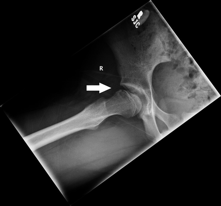 Late Presentation of Tricho-Rhino-Phalangeal Syndrome (TRPS1 Affected) Associated Hip Pathology.