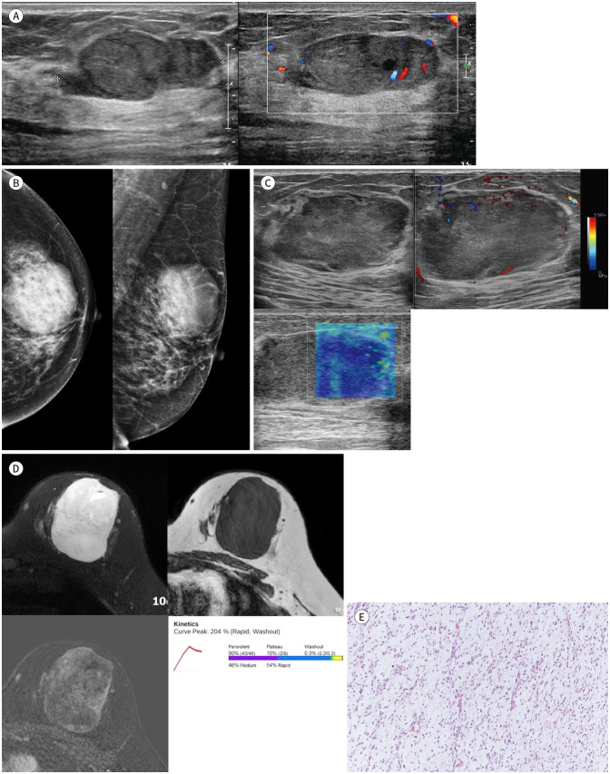 Myxoid Liposarcoma of the Breast Mimicking Phyllodes Tumor: A Case Report.