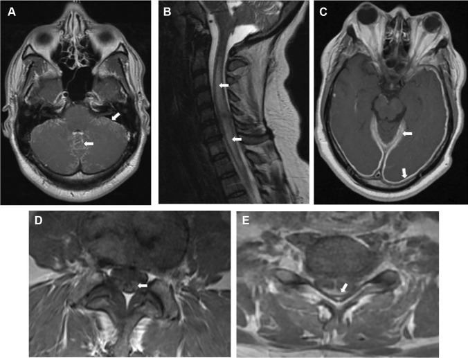 Neurosarcoidosis: Diagnostic Challenges and Mimics A Review.