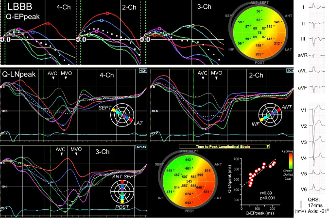 Estimation of left ventricular activation sequence in patients with heart failure using two-dimensional speckle tracking echocardiography.