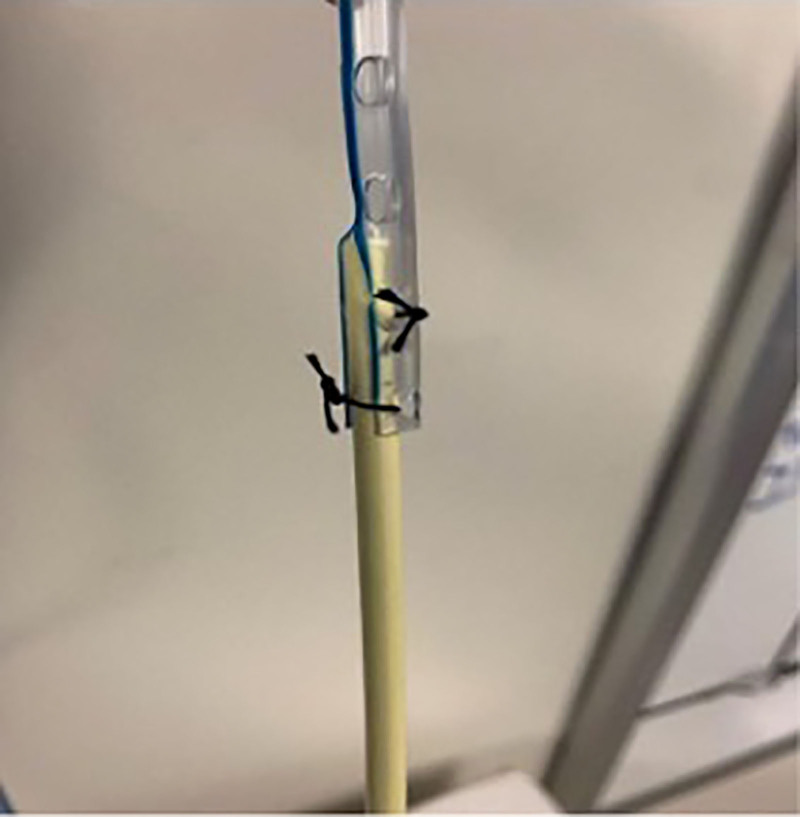 Oral to Nasal Endotracheal Tube Exchange: Modification to Enable Wider Applicability of an "Old Connector" Technique-A Case Report.