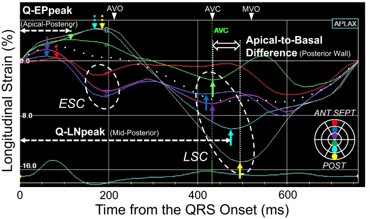 Estimation of left ventricular activation sequence in patients with heart failure using two-dimensional speckle tracking echocardiography.